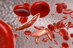 SC RED | Sickle Cell Disease News | reproductive health | image of sickled red blood cells