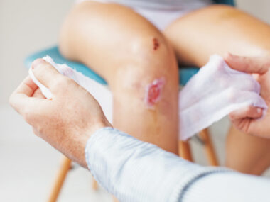 leg ulcers, sickle cell disease