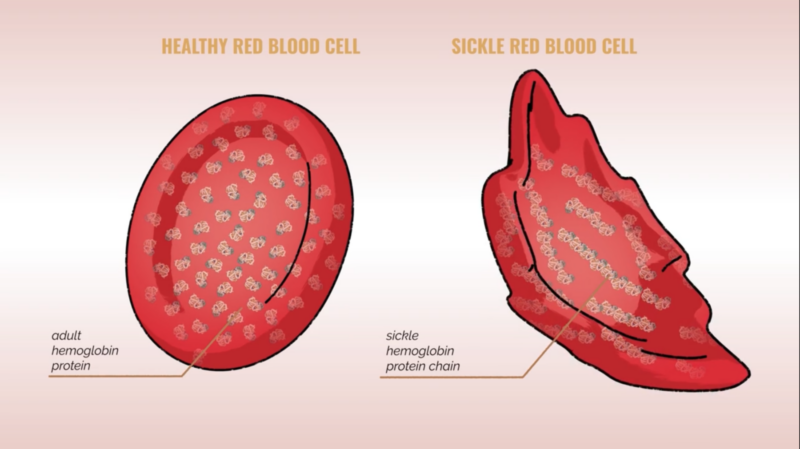 normal adult hemoglobin vs sickle hemoglobin