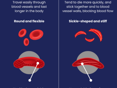 A graphic compares normal red blood cells to those seen in sickle cell disease.