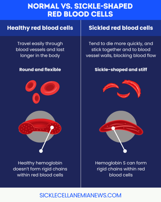 A graphic compares normal red blood cells to those seen in sickle cell disease.