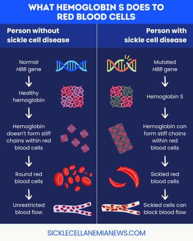 A graphic depicts what hemoglobin S does to red blood cells in people with and without sickle cell disease.